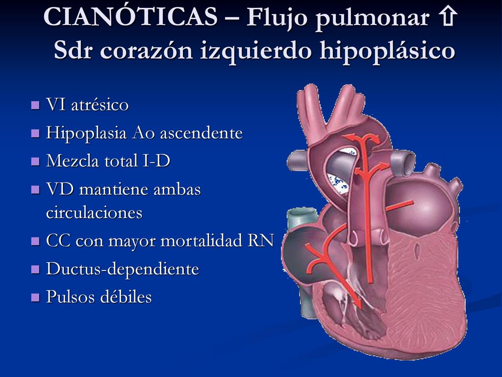 CIANÓTICAS – Flujo pulmonar  Sdr corazón izquierdo hipoplásico