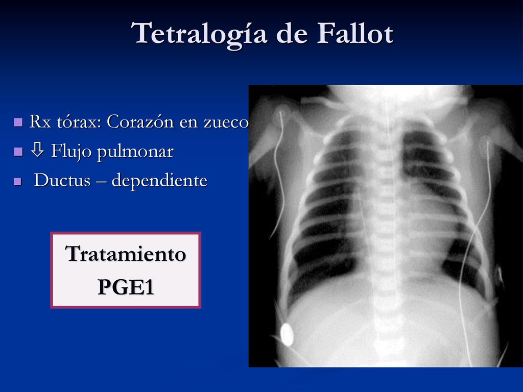 Tetralogía de Fallot Tratamiento PGE1 Rx tórax: Corazón en zueco