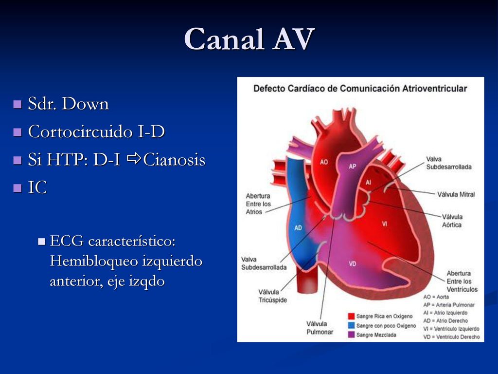 Canal AV Sdr. Down Cortocircuido I-D Si HTP: D-I Cianosis IC
