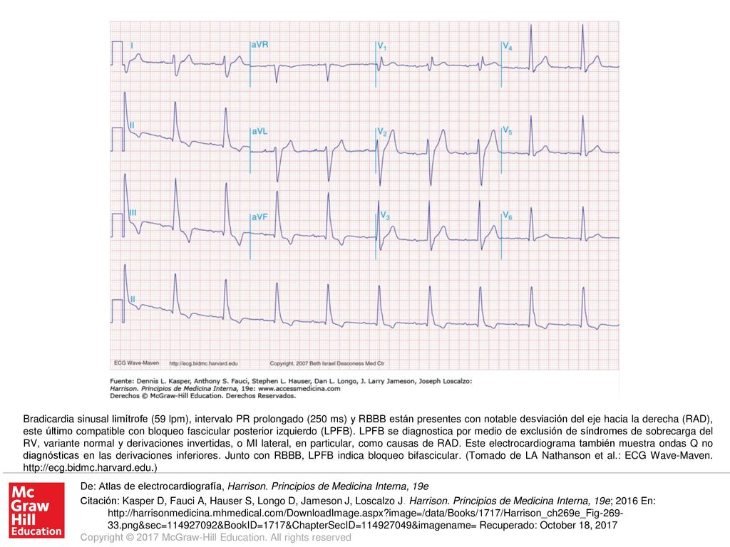 Bradicardia sinusal limítrofe (59 lpm), intervalo PR prolongado (250 ms) y RBBB están presentes con notable desviación del eje hacia la derecha (RAD), este último compatible con bloqueo fascicular posterior izquierdo (LPFB). LPFB se diagnostica por medio de exclusión de síndromes de sobrecarga del RV, variante normal y derivaciones invertidas, o MI lateral, en particular, como causas de RAD. Este electrocardiograma también muestra ondas Q no diagnósticas en las derivaciones inferiores. Junto con RBBB, LPFB indica bloqueo bifascicular. (Tomado de LA Nathanson et al.: ECG Wave-Maven.