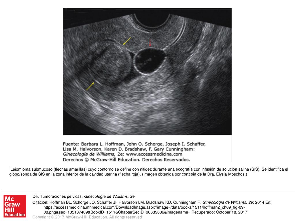 Leiomioma submucoso (flechas amarillas) cuyo contorno se define con nitidez durante una ecografía con infusión de solución salina (SIS). Se identifica el globo/sonda de SIS en la zona inferior de la cavidad uterina (flecha roja). (Imagen obtenida por cortesía de la Dra. Elysia Moschos.)