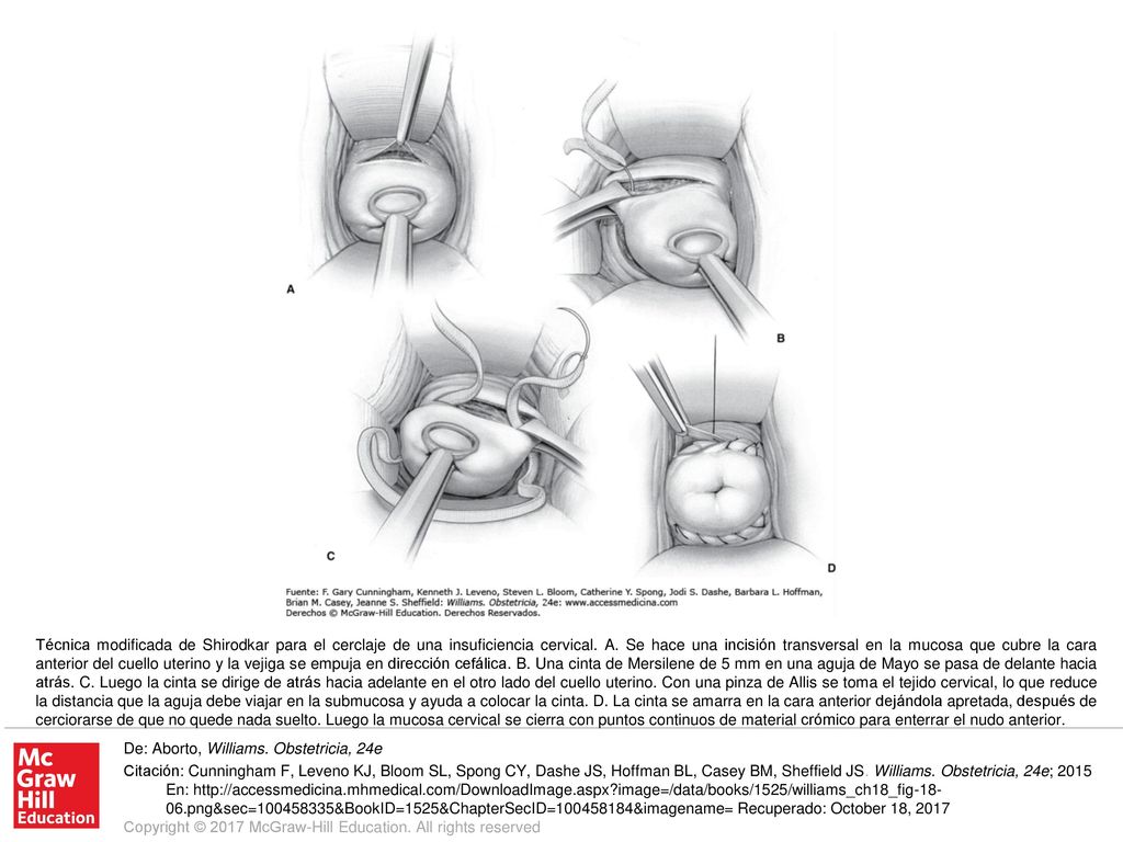 Técnica modificada de Shirodkar para el cerclaje de una insuficiencia cervical. A. Se hace una incisión transversal en la mucosa que cubre la cara anterior del cuello uterino y la vejiga se empuja en dirección cefálica. B. Una cinta de Mersilene de 5 mm en una aguja de Mayo se pasa de delante hacia atrás. C. Luego la cinta se dirige de atrás hacia adelante en el otro lado del cuello uterino. Con una pinza de Allis se toma el tejido cervical, lo que reduce la distancia que la aguja debe viajar en la submucosa y ayuda a colocar la cinta. D. La cinta se amarra en la cara anterior dejándola apretada, después de cerciorarse de que no quede nada suelto. Luego la mucosa cervical se cierra con puntos continuos de material crómico para enterrar el nudo anterior.