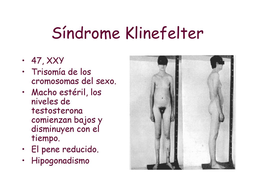 Síndrome Klinefelter 47, XXY Trisomía de los cromosomas del sexo.
