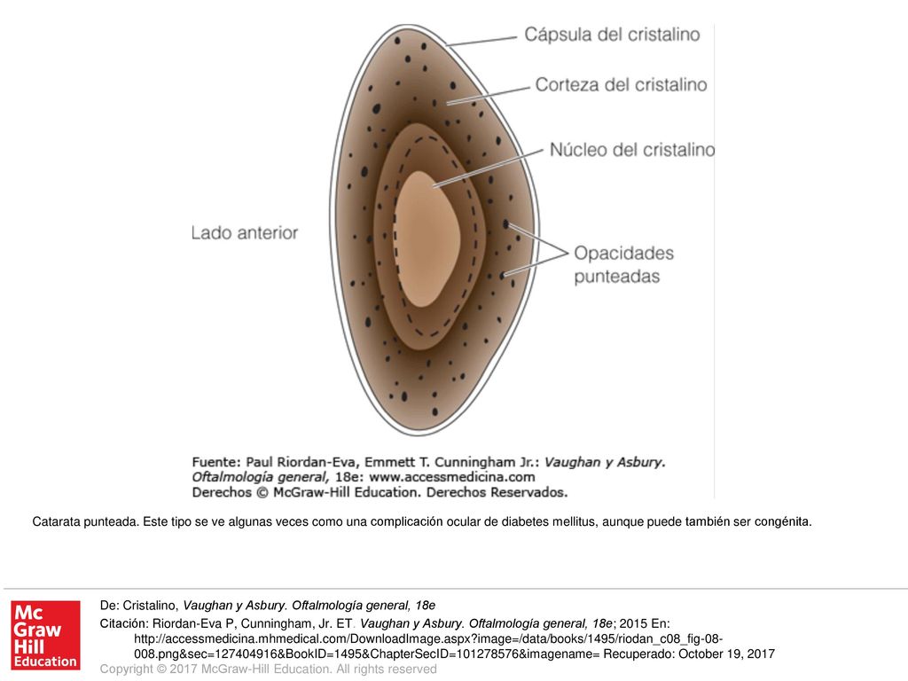 Catarata punteada. Este tipo se ve algunas veces como una complicación ocular de diabetes mellitus, aunque puede también ser congénita.