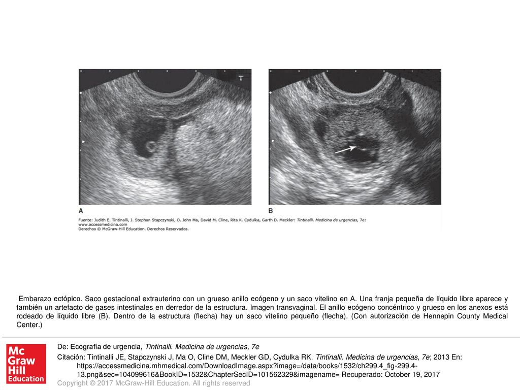 Embarazo ectópico. Saco gestacional extrauterino con un grueso anillo ecógeno y un saco vitelino en A. Una franja pequeña de líquido libre aparece y también un artefacto de gases intestinales en derredor de la estructura. Imagen transvaginal. El anillo ecógeno concéntrico y grueso en los anexos está rodeado de líquido libre (B). Dentro de la estructura (flecha) hay un saco vitelino pequeño (flecha). (Con autorización de Hennepin County Medical Center.)