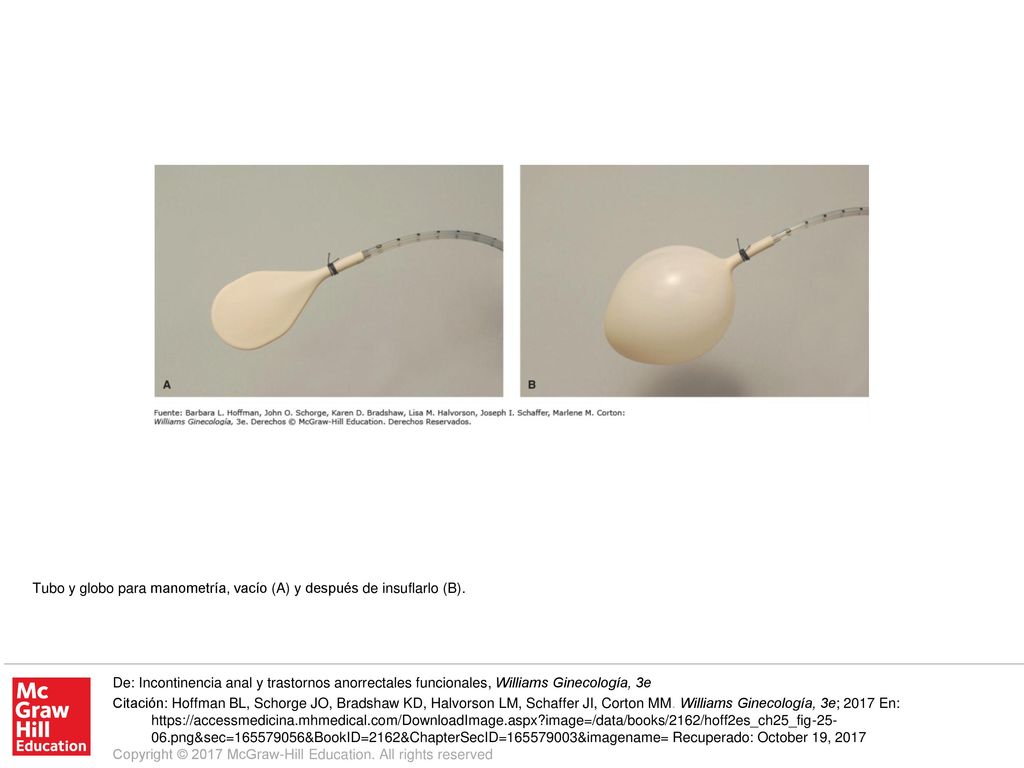 Tubo y globo para manometría, vacío (A) y después de insuflarlo (B).