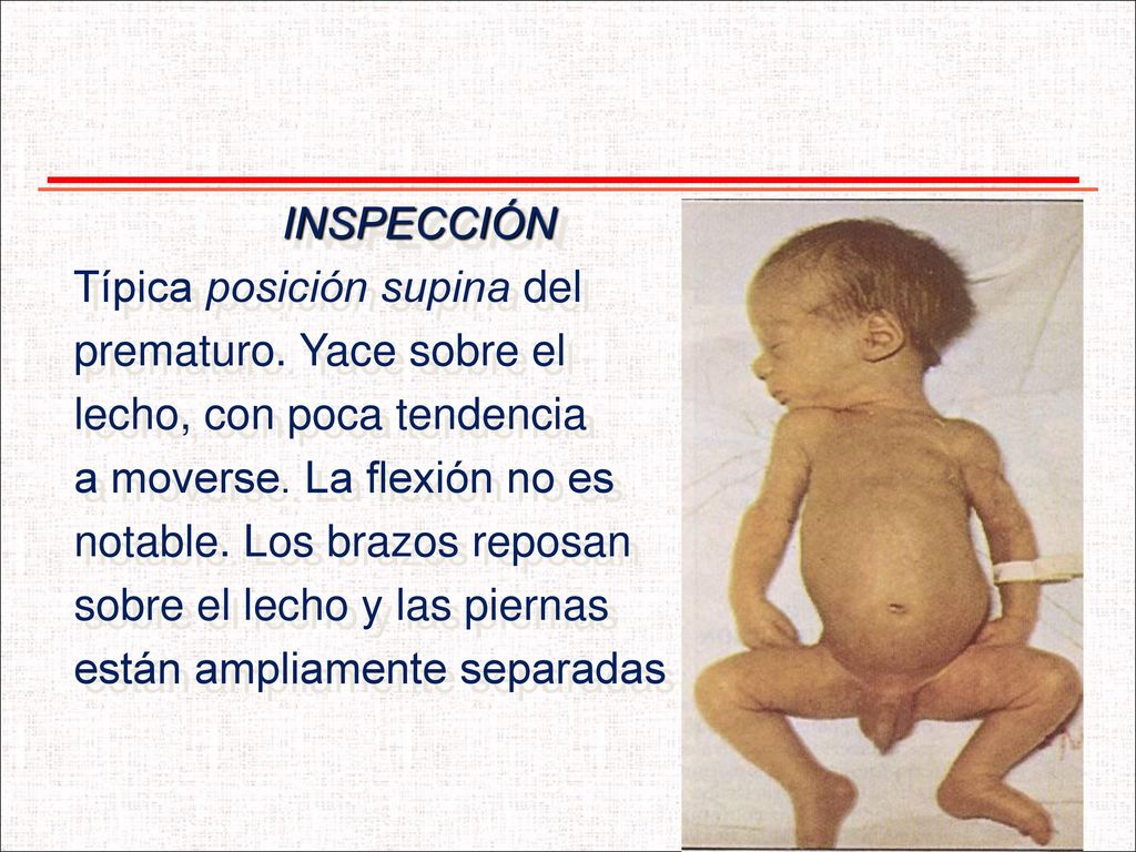 INSPECCIÓN Típica posición supina del. prematuro. Yace sobre el. lecho, con poca tendencia. a moverse. La flexión no es.