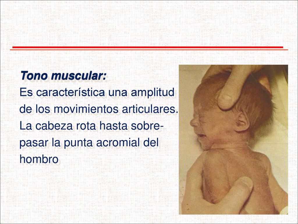 Tono muscular: Es característica una amplitud. de los movimientos articulares. La cabeza rota hasta sobre-