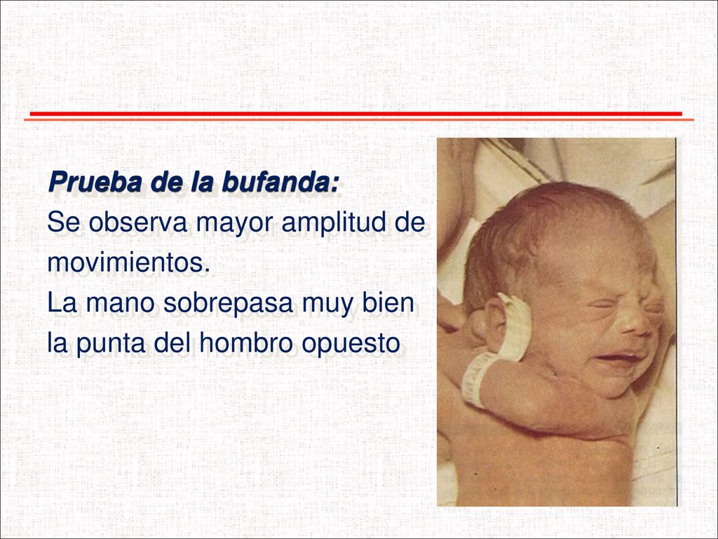 Prueba de la bufanda: Se observa mayor amplitud de.