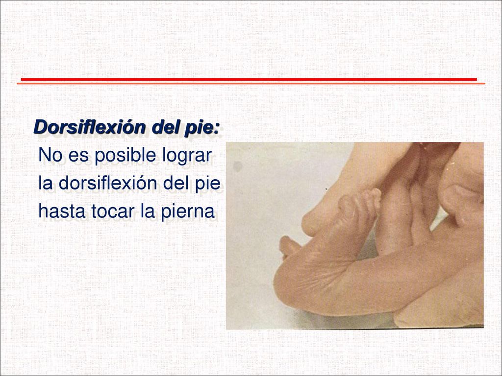 Dorsiflexión del pie: No es posible lograr la dorsiflexión del pie hasta tocar la pierna