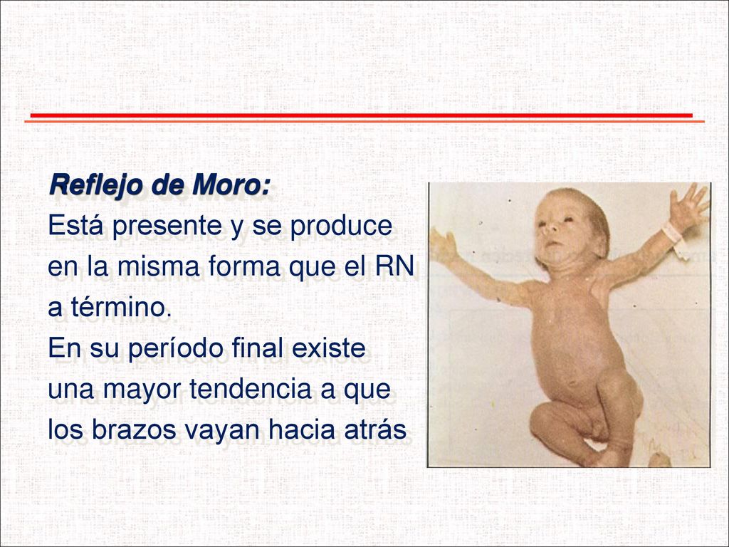 Reflejo de Moro: Está presente y se produce. en la misma forma que el RN. a término. En su período final existe.