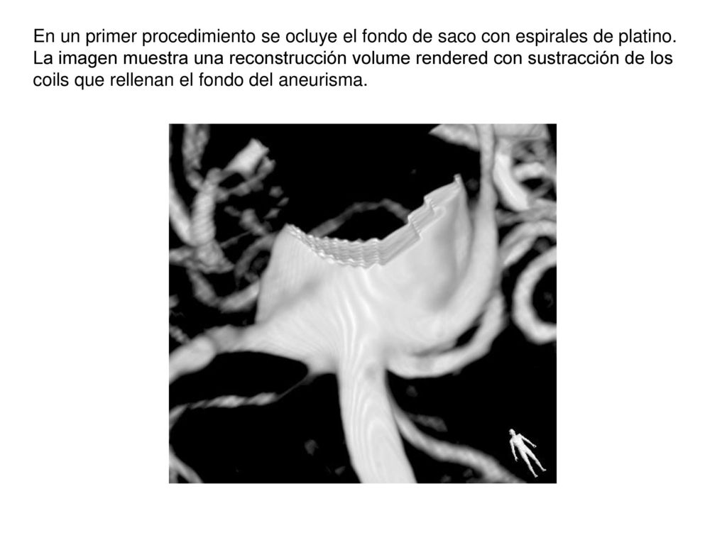 En un primer procedimiento se ocluye el fondo de saco con espirales de platino.