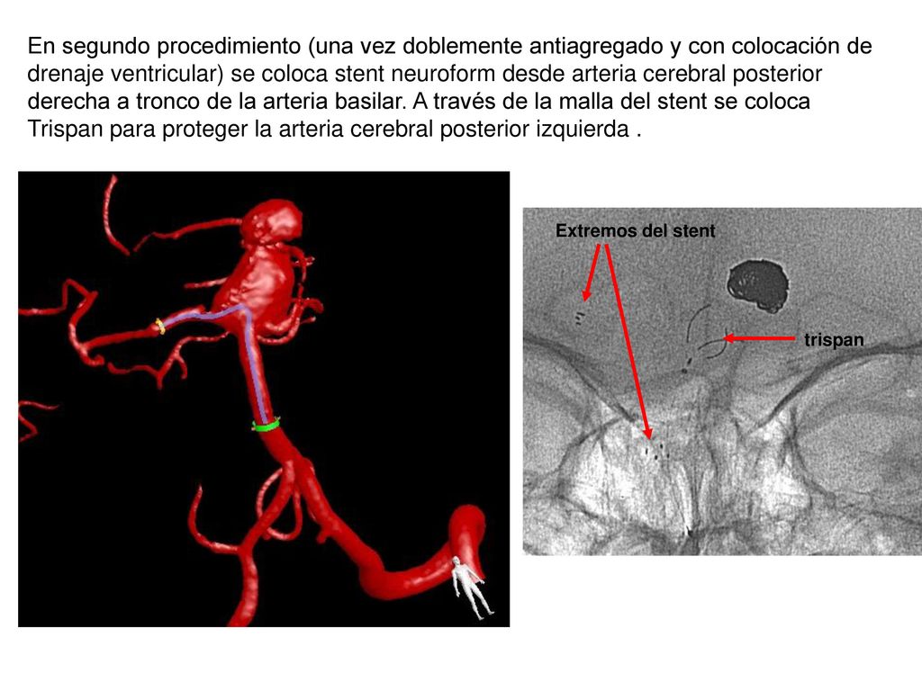 En segundo procedimiento (una vez doblemente antiagregado y con colocación de drenaje ventricular) se coloca stent neuroform desde arteria cerebral posterior derecha a tronco de la arteria basilar. A través de la malla del stent se coloca Trispan para proteger la arteria cerebral posterior izquierda .