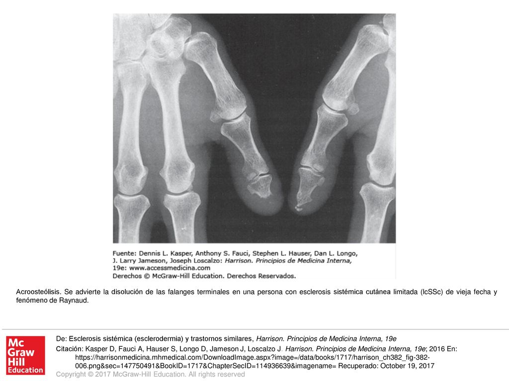 Acroosteólisis. Se advierte la disolución de las falanges terminales en una persona con esclerosis sistémica cutánea limitada (lcSSc) de vieja fecha y fenómeno de Raynaud.
