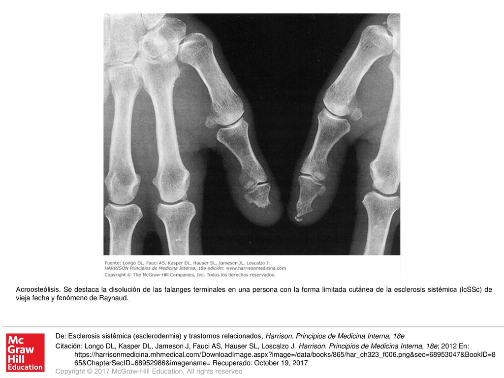 Acroosteólisis. Se destaca la disolución de las falanges terminales en una persona con la forma limitada cutánea de la esclerosis sistémica (lcSSc) de vieja fecha y fenómeno de Raynaud.