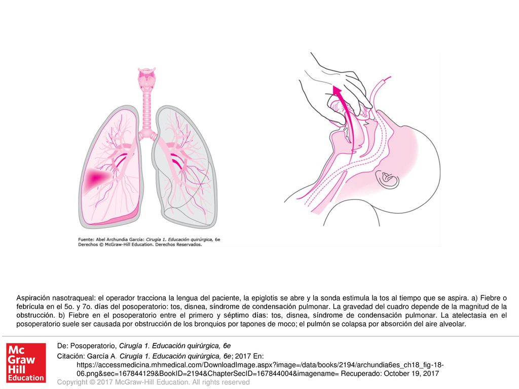 Aspiración nasotraqueal: el operador tracciona la lengua del paciente, la epiglotis se abre y la sonda estimula la tos al tiempo que se aspira. a) Fiebre o febrícula en el 5o. y 7o. días del posoperatorio: tos, disnea, síndrome de condensación pulmonar. La gravedad del cuadro depende de la magnitud de la obstrucción. b) Fiebre en el posoperatorio entre el primero y séptimo días: tos, disnea, síndrome de condensación pulmonar. La atelectasia en el posoperatorio suele ser causada por obstrucción de los bronquios por tapones de moco; el pulmón se colapsa por absorción del aire alveolar.