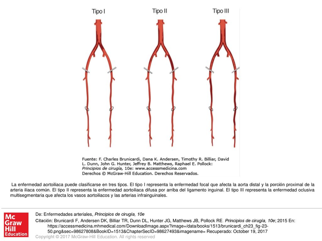 La enfermedad aortoiliaca puede clasificarse en tres tipos