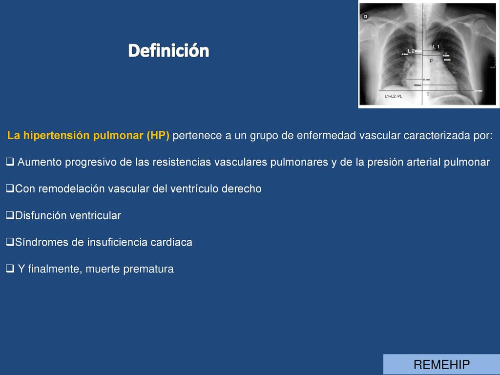 Definición La hipertensión pulmonar (HP) pertenece a un grupo de enfermedad vascular caracterizada por: