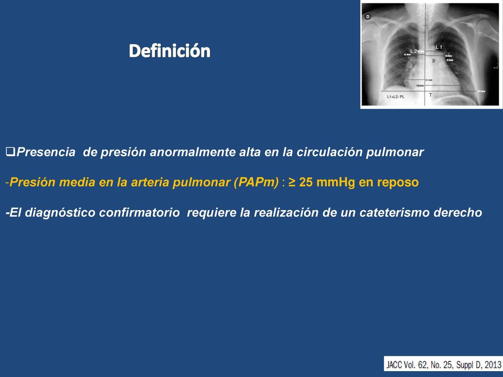 Definición Presencia de presión anormalmente alta en la circulación pulmonar. -Presión media en la arteria pulmonar (PAPm) : ≥ 25 mmHg en reposo.