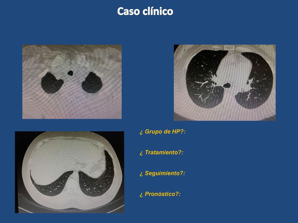 Caso clínico ¿ Grupo de HP : ¿ Tratamiento : ¿ Seguimiento :