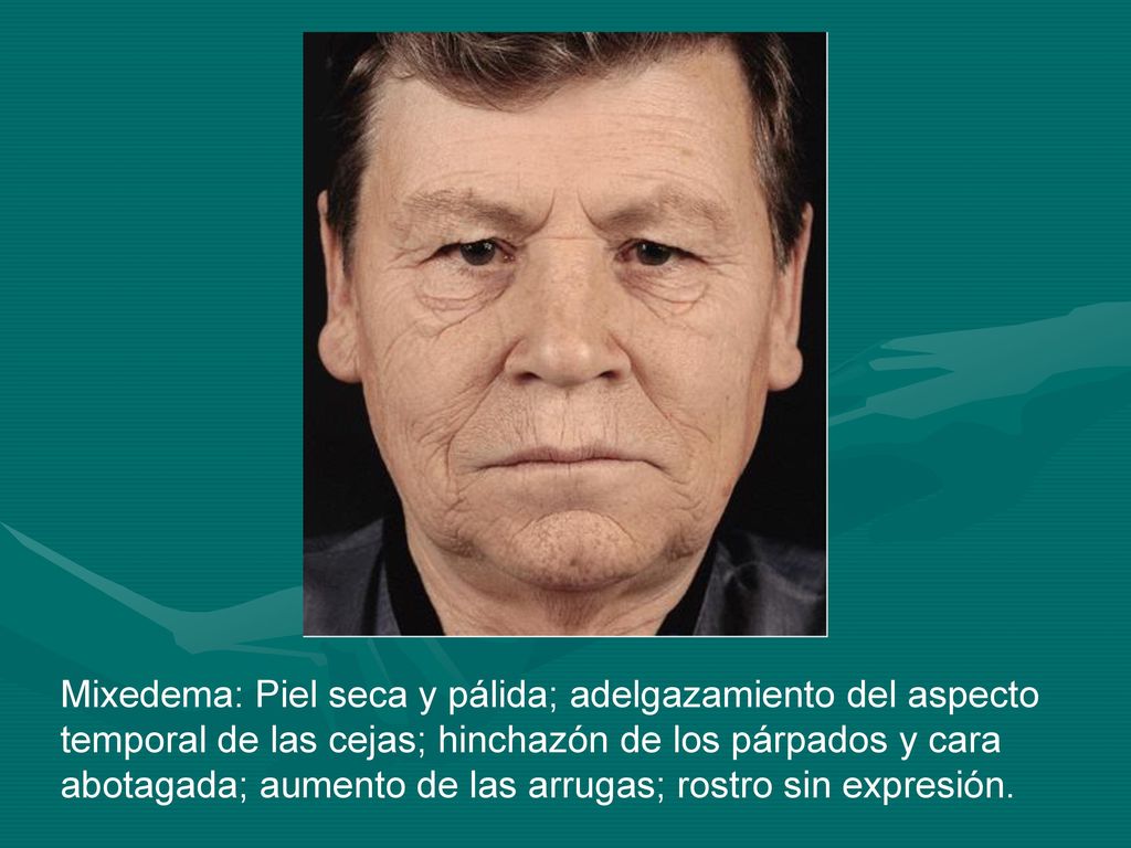 Mixedema: Piel seca y pálida; adelgazamiento del aspecto temporal de las cejas; hinchazón de los párpados y cara abotagada; aumento de las arrugas; rostro sin expresión.