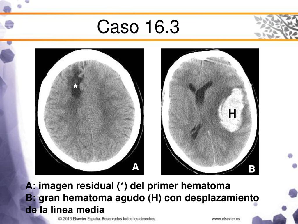 Caso 16.3 * H A B A: imagen residual (*) del primer hematoma