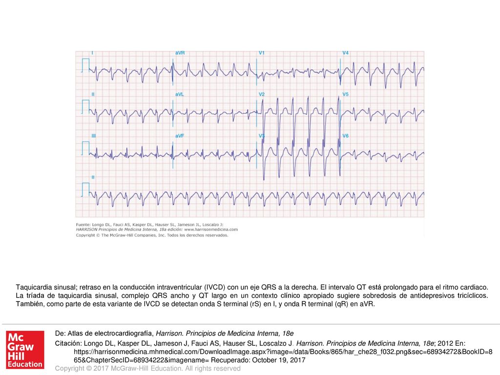 Taquicardia sinusal; retraso en la conducción intraventricular (IVCD) con un eje QRS a la derecha. El intervalo QT está prolongado para el ritmo cardiaco. La tríada de taquicardia sinusal, complejo QRS ancho y QT largo en un contexto clínico apropiado sugiere sobredosis de antidepresivos tricíclicos. También, como parte de esta variante de IVCD se detectan onda S terminal (rS) en I, y onda R terminal (qR) en aVR.