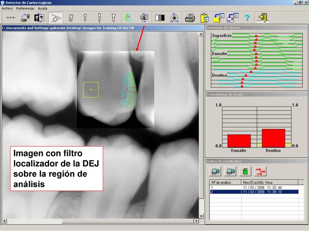 Imagen con filtro localizador de la DEJ sobre la región de análisis
