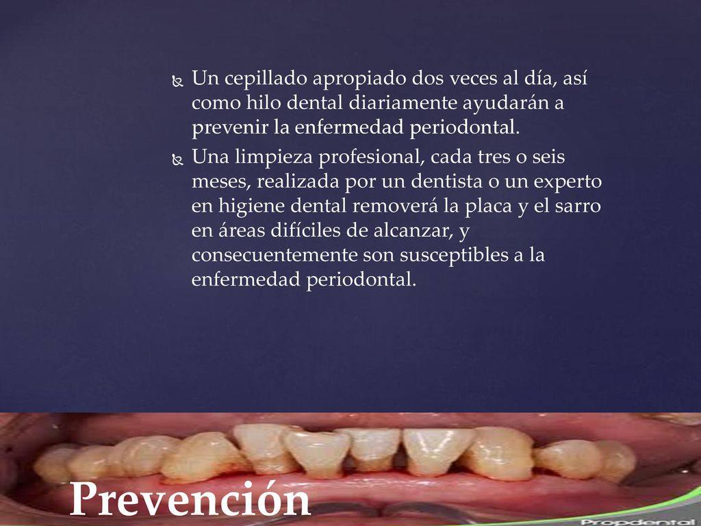 Un cepillado apropiado dos veces al día, así como hilo dental diariamente ayudarán a prevenir la enfermedad periodontal.
