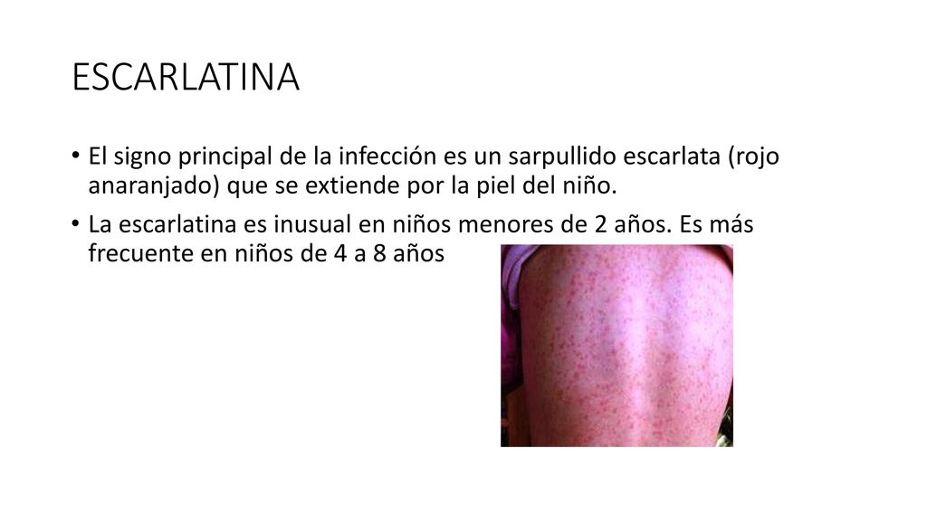 ESCARLATINA El signo principal de la infección es un sarpullido escarlata (rojo anaranjado) que se extiende por la piel del niño.