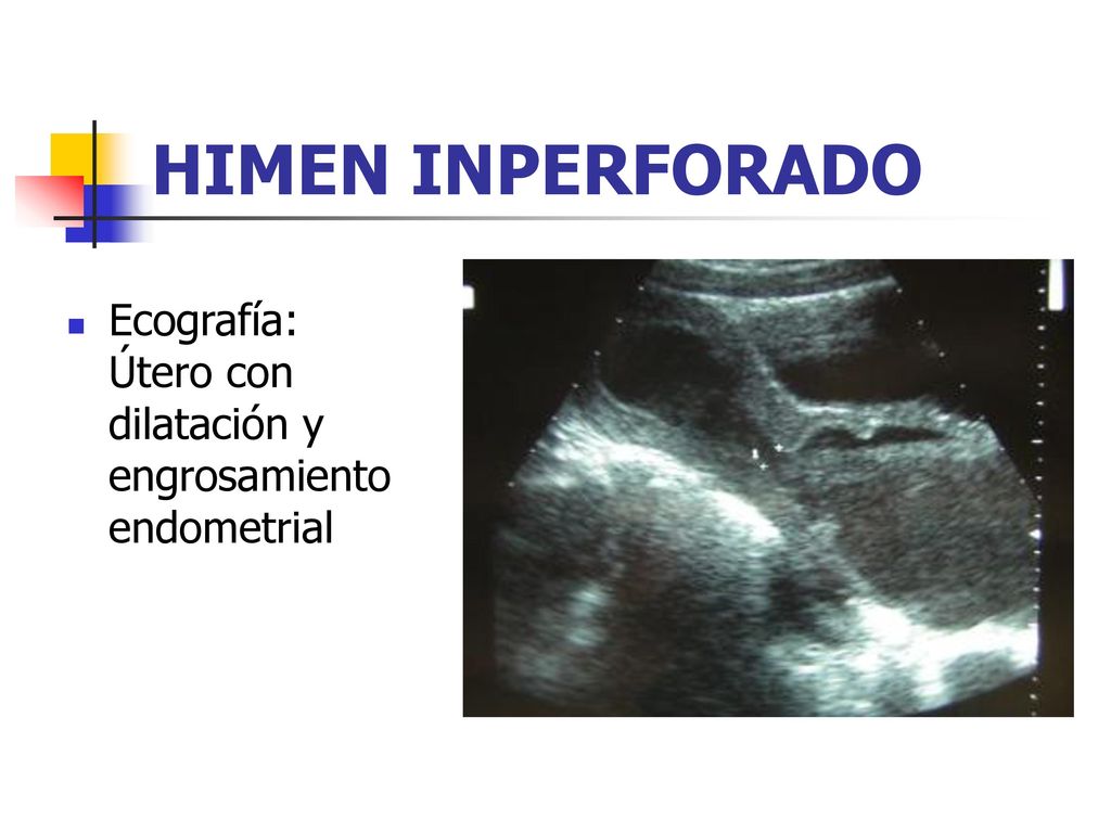 HIMEN INPERFORADO Ecografía: Útero con dilatación y engrosamiento endometrial. Publicaciones de PortalesMedicos.com.