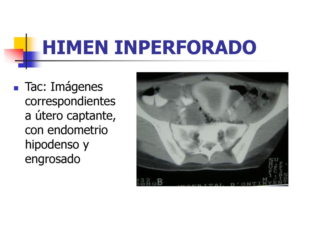 HIMEN INPERFORADO Tac: Imágenes correspondientes a útero captante, con endometrio hipodenso y engrosado.