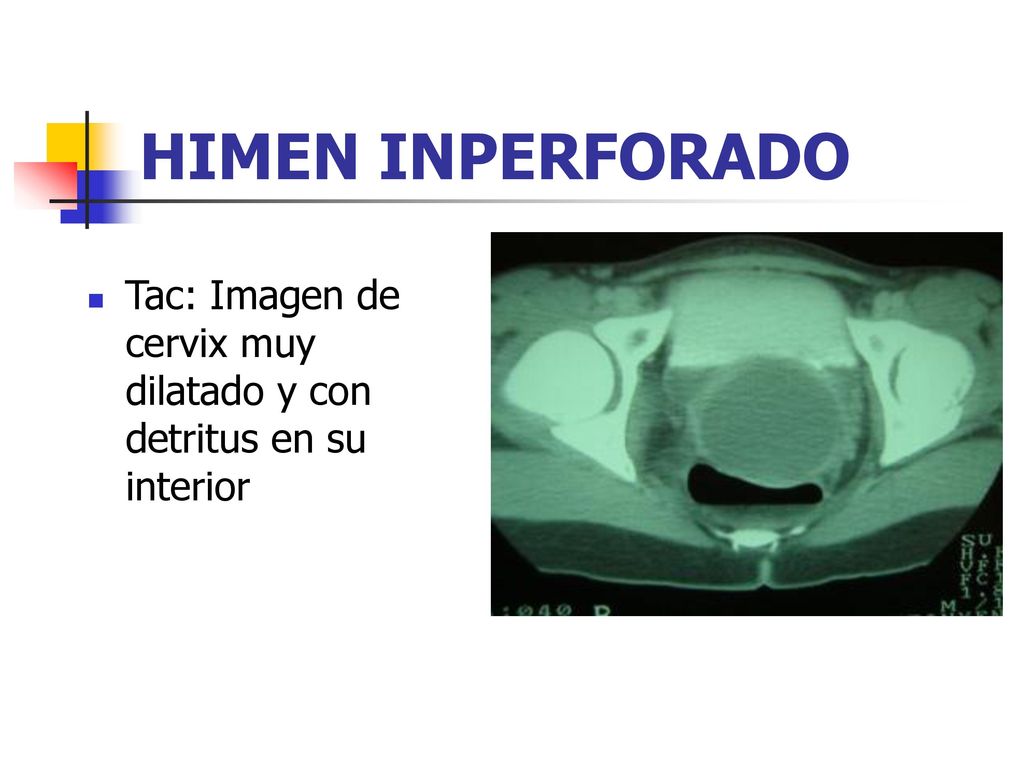 HIMEN INPERFORADO Tac: Imagen de cervix muy dilatado y con detritus en su interior. Publicaciones de PortalesMedicos.com.