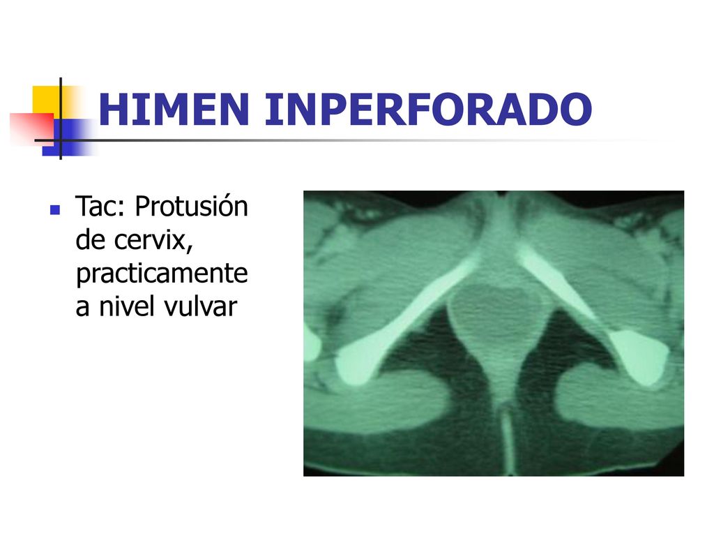 HIMEN INPERFORADO Tac: Protusión de cervix, practicamente a nivel vulvar. Publicaciones de PortalesMedicos.com.