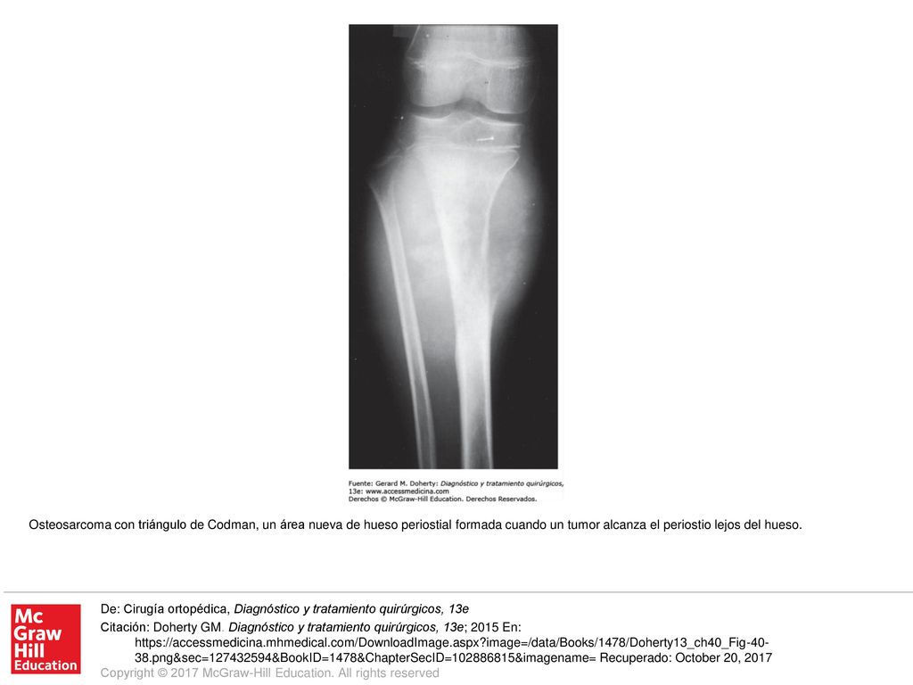 Osteosarcoma con triángulo de Codman, un área nueva de hueso periostial formada cuando un tumor alcanza el periostio lejos del hueso.