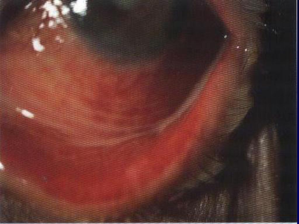 INYECCIÒN CONJUNTIVAL Y SECRECIÒN OCULAR MUCOPURULENTA ABUNDANTE EN CONJUNTIVITIS AGUDAS.