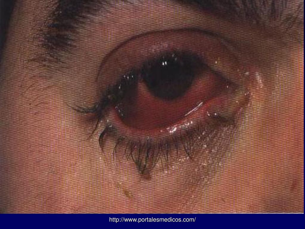 INYECCIÒN CONJUNTIVAL , SECRECIÒN MUCOSA ABUNDANTE EN CASO DE CONJUNTIVITIS AGUDA.