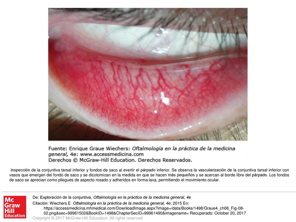 Inspección de la conjuntiva tarsal inferior y fondos de saco al evertir el párpado inferior. Se observa la vascularización de la conjuntiva tarsal inferior con vasos que emergen del fondo de saco y se dicotomizan en la medida en que se hacen más pequeños y se acercan al borde libre del párpado. Los fondos de saco se aprecian como pliegues de aspecto rosado y adheridos en forma laxa, permitiendo el movimiento ocular.