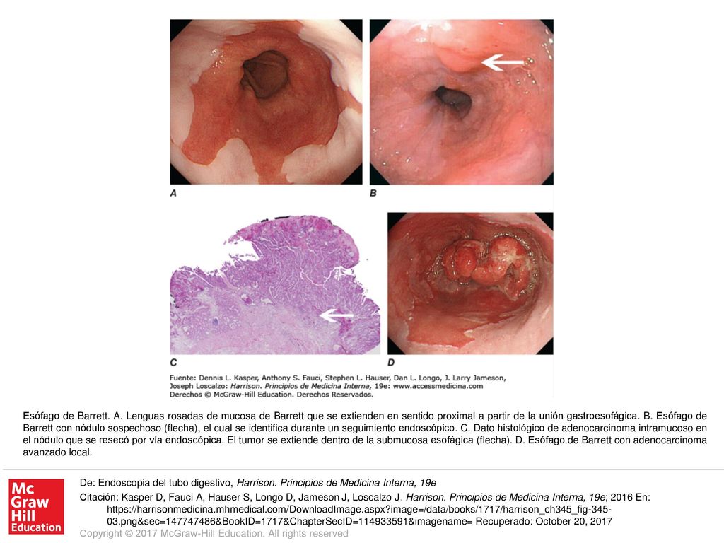 Esófago de Barrett. A. Lenguas rosadas de mucosa de Barrett que se extienden en sentido proximal a partir de la unión gastroesofágica. B. Esófago de Barrett con nódulo sospechoso (flecha), el cual se identifica durante un seguimiento endoscópico. C. Dato histológico de adenocarcinoma intramucoso en el nódulo que se resecó por vía endoscópica. El tumor se extiende dentro de la submucosa esofágica (flecha). D. Esófago de Barrett con adenocarcinoma avanzado local.