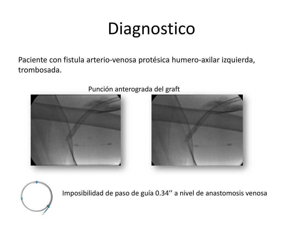 Diagnostico Paciente con fistula arterio-venosa protésica humero-axilar izquierda, trombosada. Punción anterograda del graft.