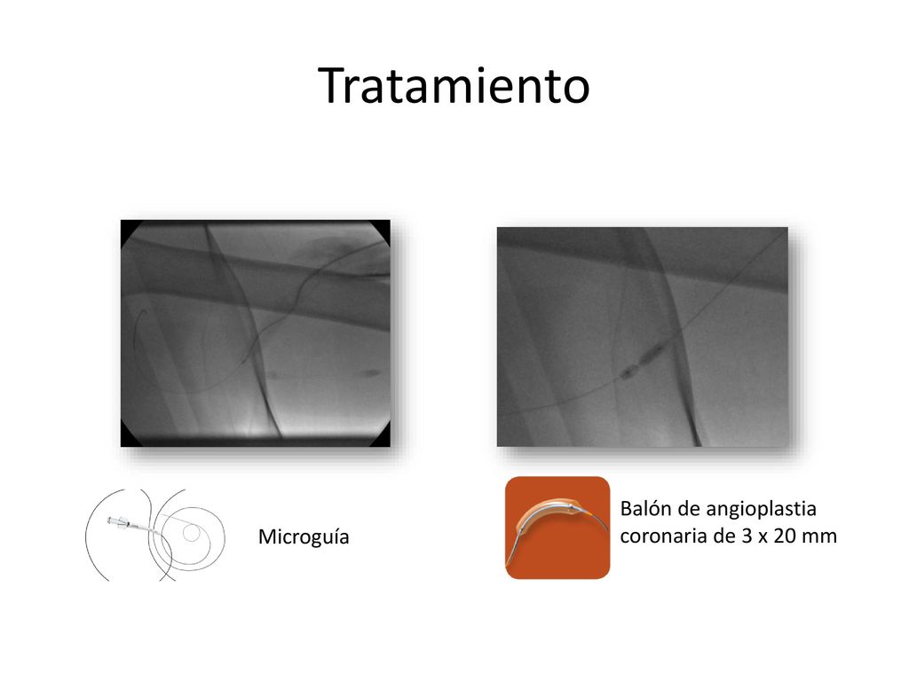 Tratamiento Balón de angioplastia coronaria de 3 x 20 mm Microguía