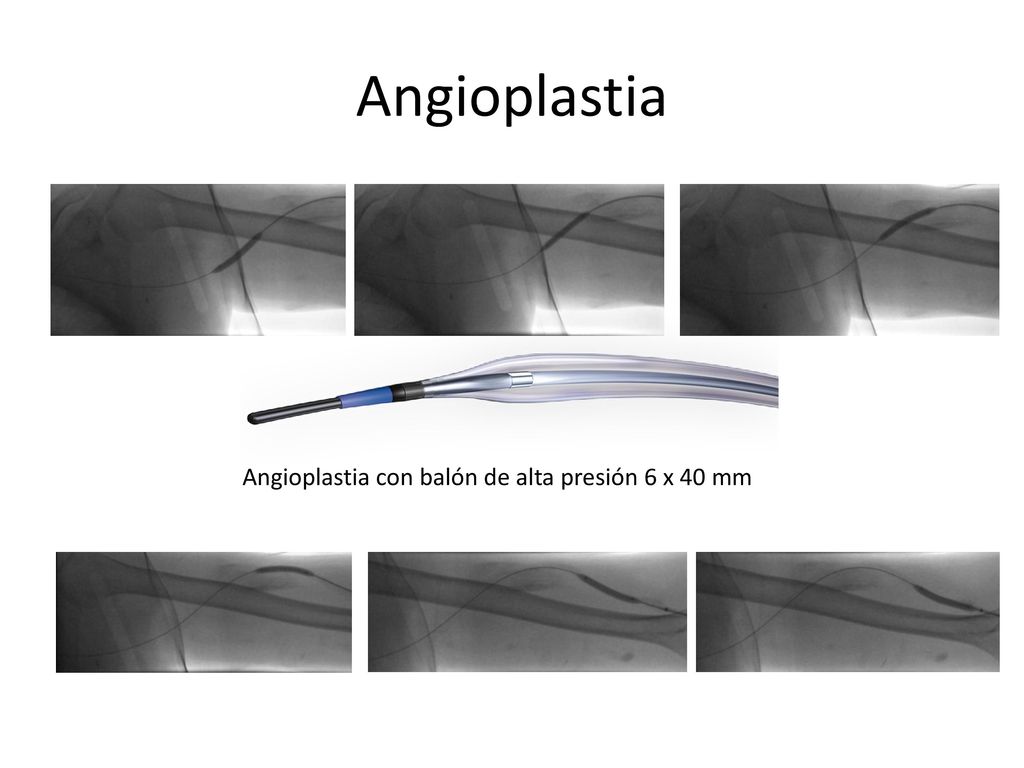 Angioplastia Angioplastia con balón de alta presión 6 x 40 mm