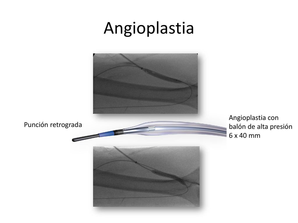 Angioplastia Angioplastia con balón de alta presión 6 x 40 mm