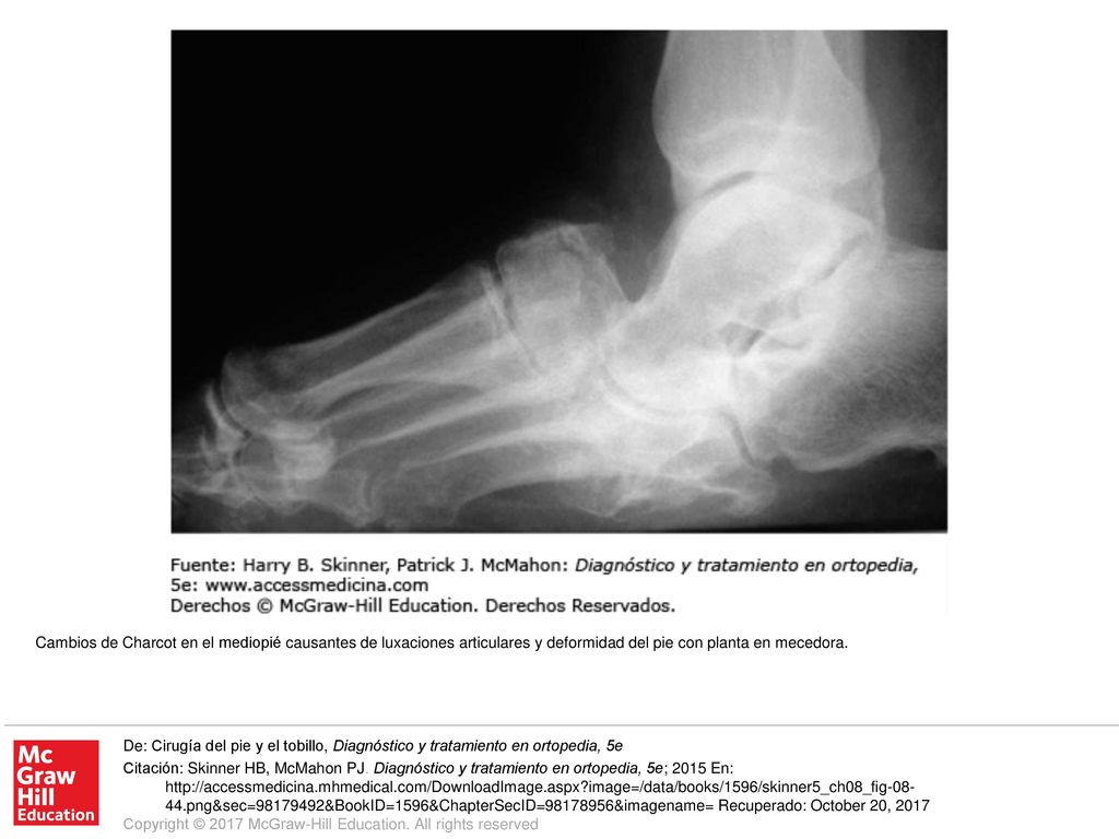 Cambios de Charcot en el mediopié causantes de luxaciones articulares y deformidad del pie con planta en mecedora.