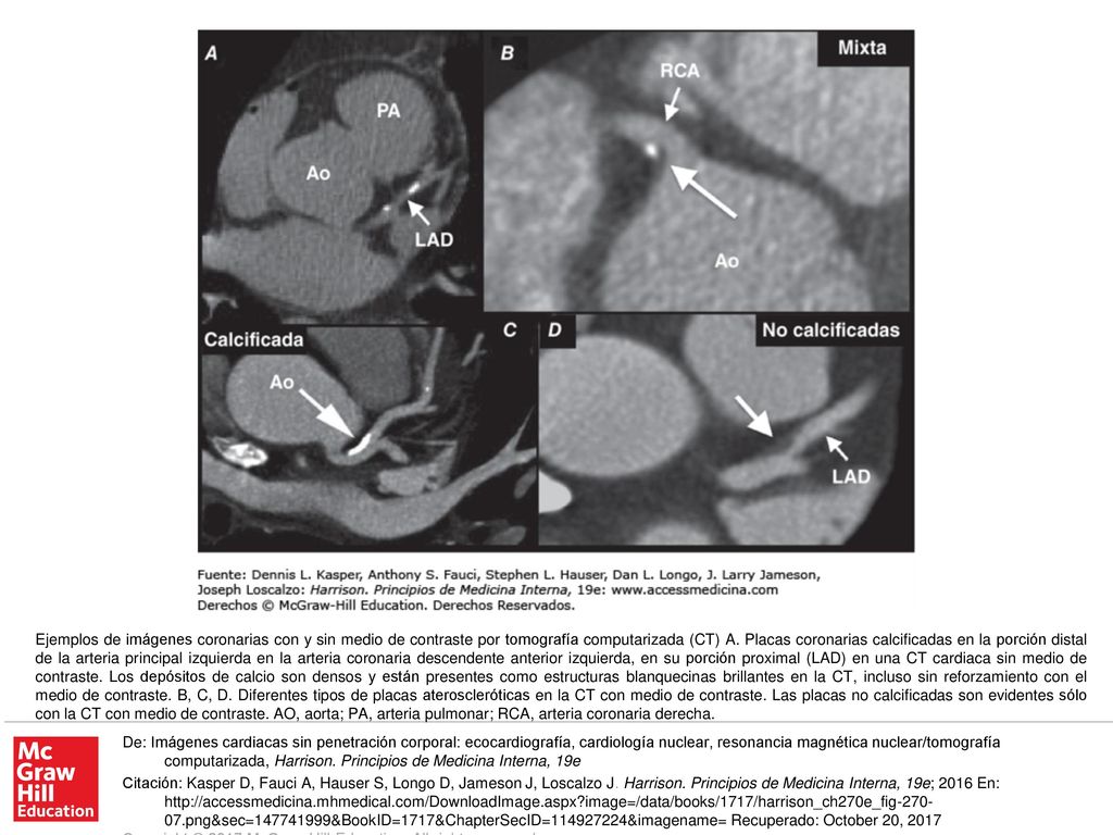Ejemplos de imágenes coronarias con y sin medio de contraste por tomografía computarizada (CT) A. Placas coronarias calcificadas en la porción distal de la arteria principal izquierda en la arteria coronaria descendente anterior izquierda, en su porción proximal (LAD) en una CT cardiaca sin medio de contraste. Los depósitos de calcio son densos y están presentes como estructuras blanquecinas brillantes en la CT, incluso sin reforzamiento con el medio de contraste. B, C, D. Diferentes tipos de placas ateroscleróticas en la CT con medio de contraste. Las placas no calcificadas son evidentes sólo con la CT con medio de contraste. AO, aorta; PA, arteria pulmonar; RCA, arteria coronaria derecha.