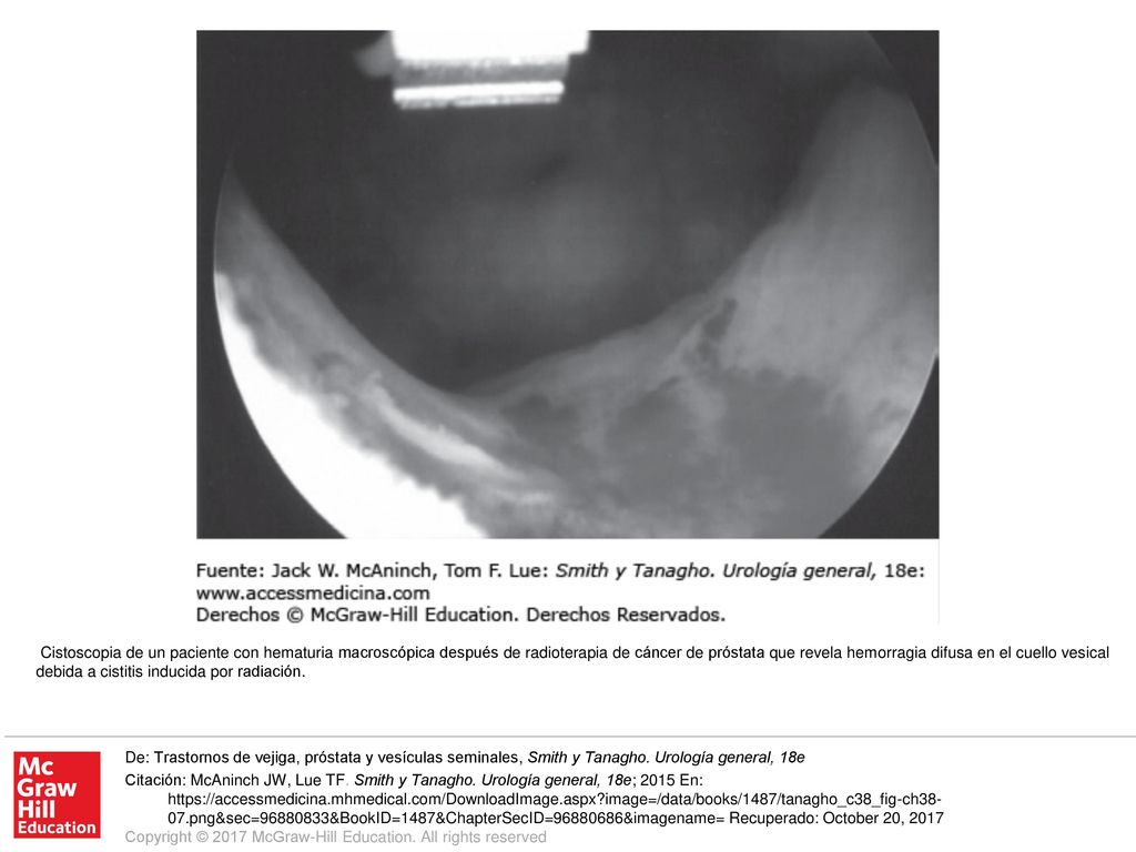 Cistoscopia de un paciente con hematuria macroscópica después de radioterapia de cáncer de próstata que revela hemorragia difusa en el cuello vesical debida a cistitis inducida por radiación.