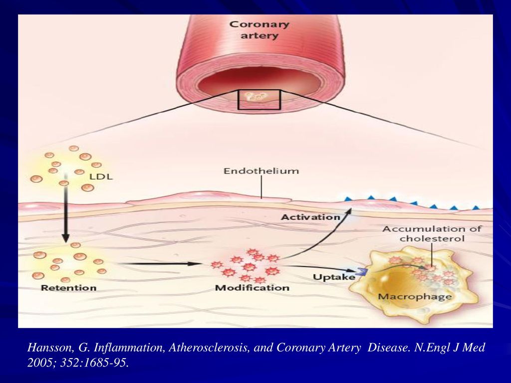 Hansson, G. Inflammation, Atherosclerosis, and Coronary Artery Disease