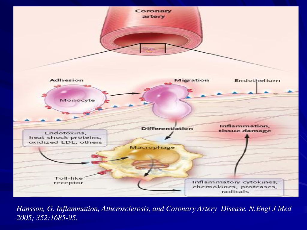 Hansson, G. Inflammation, Atherosclerosis, and Coronary Artery Disease