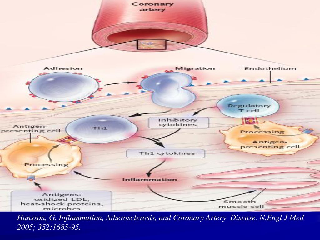 Hansson, G. Inflammation, Atherosclerosis, and Coronary Artery Disease