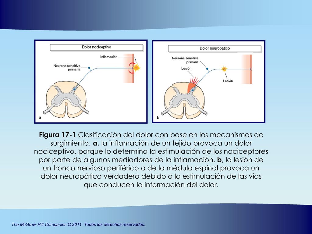 Figura 17-1 Clasificación del dolor con base en los mecanismos de surgimiento.